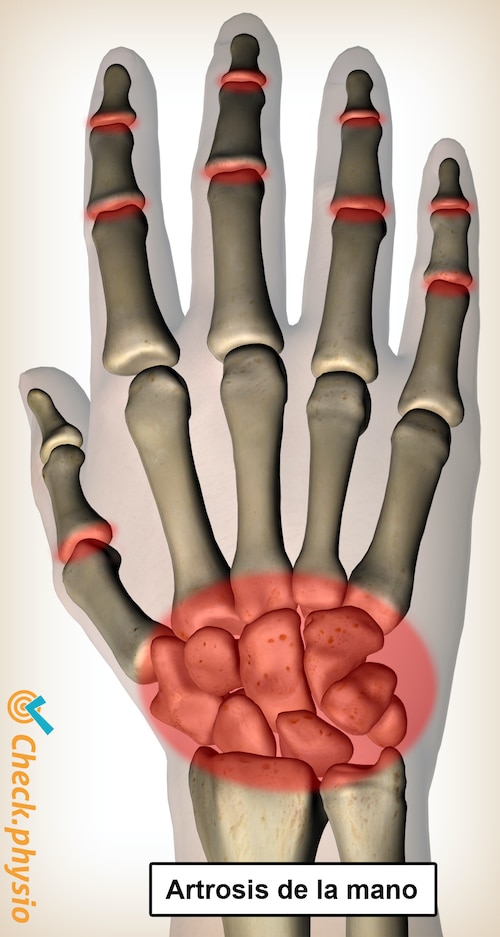 mano dolor de artrosis ubicación