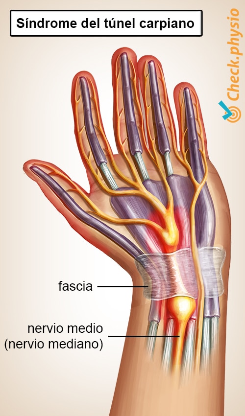 mano síndrome del túnel carpiano STC pinzamiento del nervio mediano