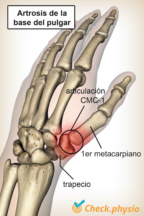 mano base del pulgar artrosis hueso trapecio metacarpiano I cmc 1 articulación