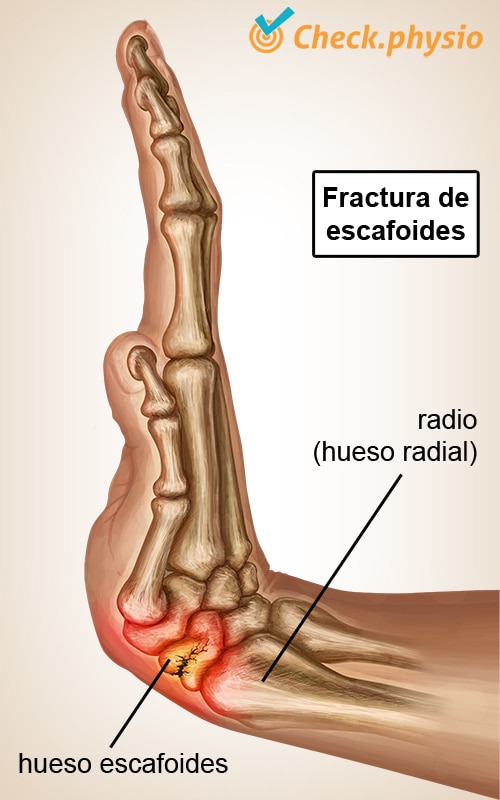 mano fractura de escafoides