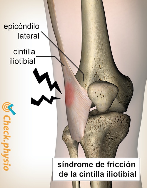 afbeelding_alt_knie-iliotibiaal-band-syndroom-laterale-epicondyl