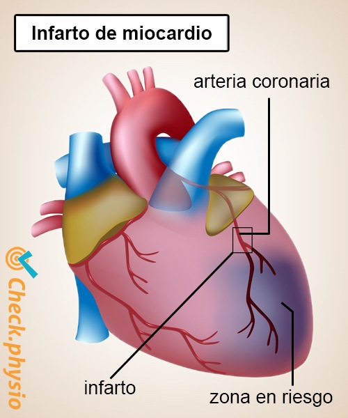 infarto anatomía de la arteria coronaria