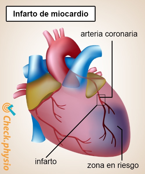 infarto anatomía de la arteria coronaria