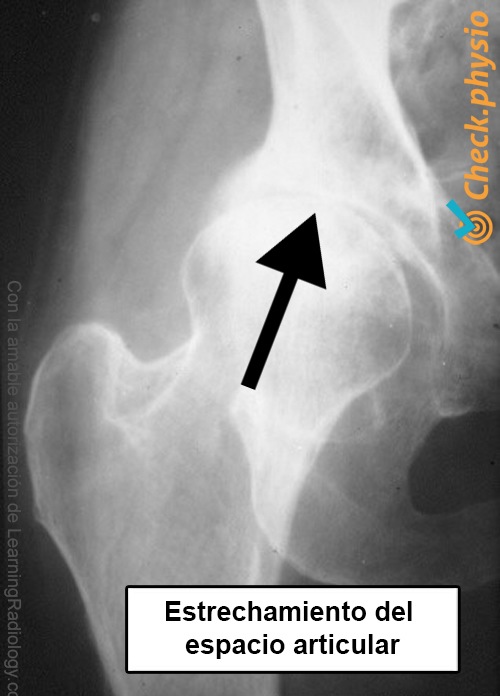 artrosis de cadera radiografía línea articular