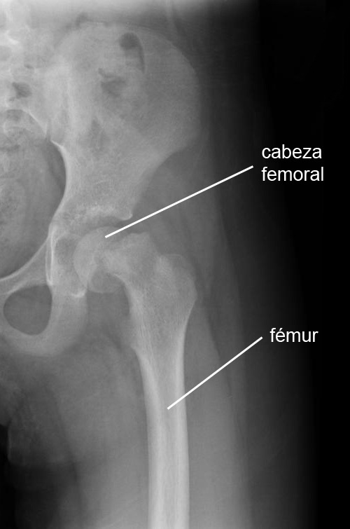 cadera epifisiolisis cabeza femoral radiografía