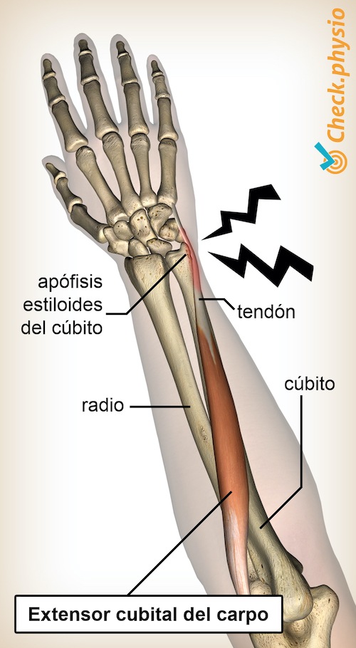 brazo antebrazo tendinitis del extensor carpi-ulnaris tendinopatía