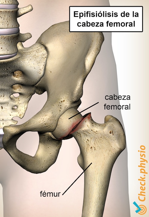 cadera epifisiolisis cabeza femoral