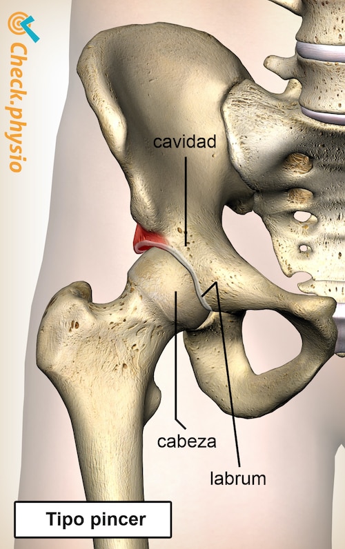 cadera pinzamiento femoroacetabular fai pincer