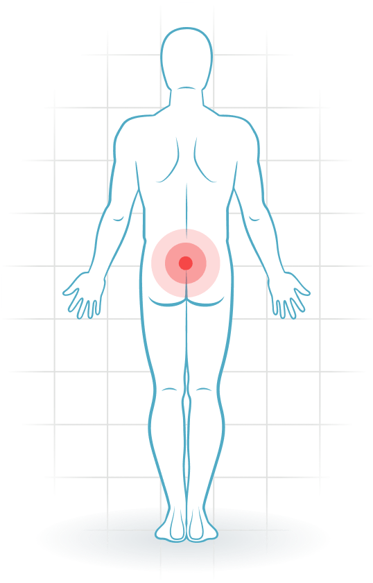 pijnlocatie Dolor de la articulación sacroilíaca