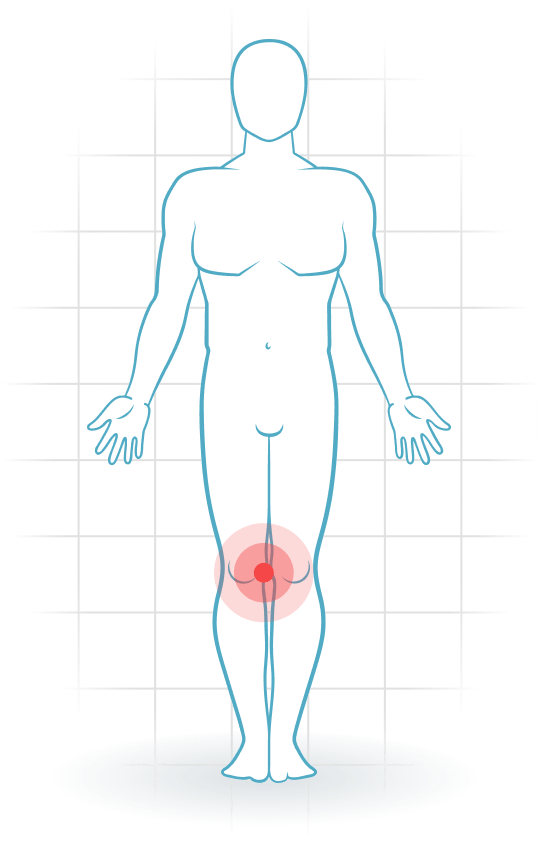 pijnlocatie Lesión del ligamento colateral medial de la rodilla