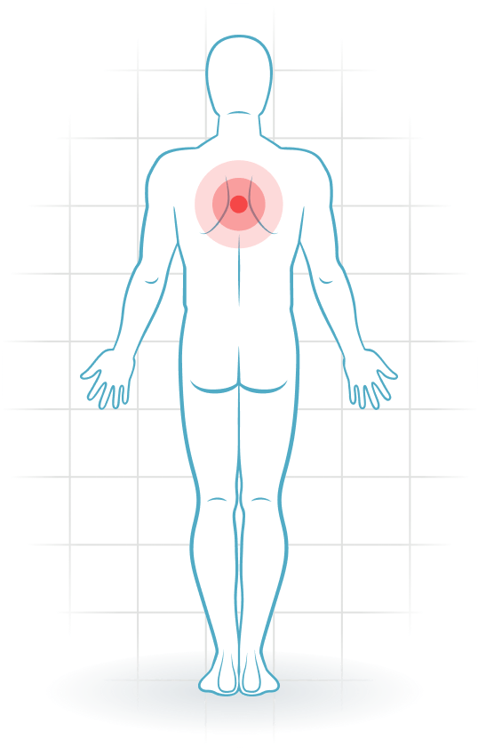 pijnlocatie Lesión muscular de la parte superior de la espalda